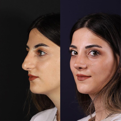 عکس های قبل و بعد جراحی زیبایی صورت | از عمل بینی تا ژل لب