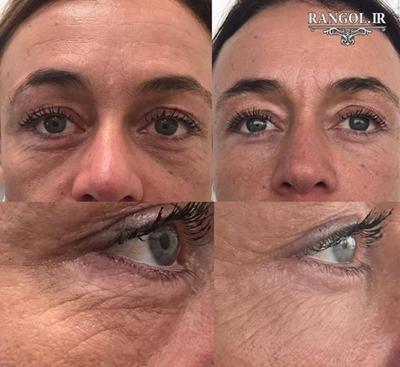 تاثیر میکرونیدلینگ پوست صورت چین چروک