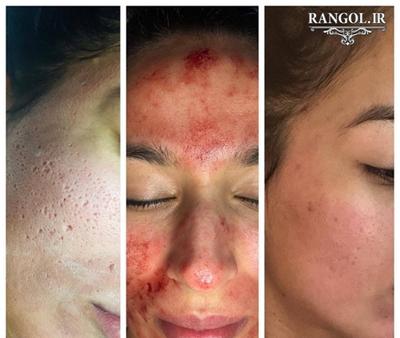تاثیر میکرونیدلینگ پوست صورت اسکار جای جوش