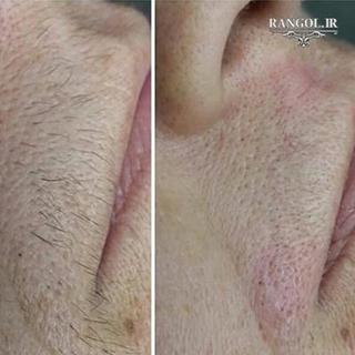 قیمت هزینه جلسه لیزر مو زائد صورت بدن قیمت هزینه جلسه لیزر مو زائد صورت بدن