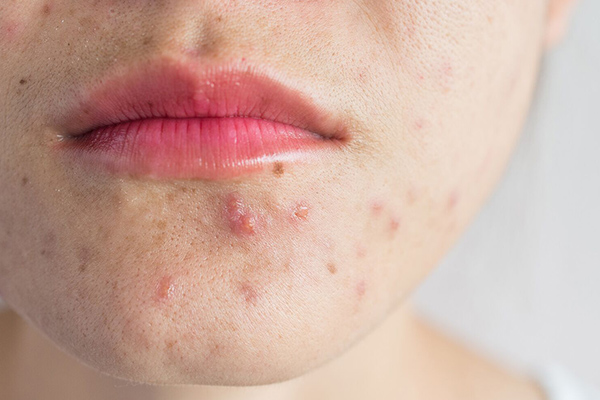 چرا بعد از شیو جوش میزنیم