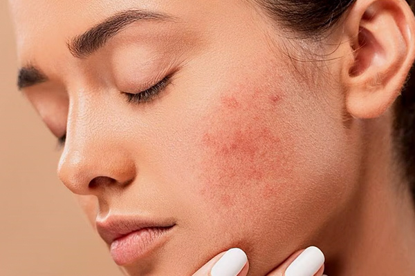 چرا بعد از اصلاح و شیو جوش میزنیم