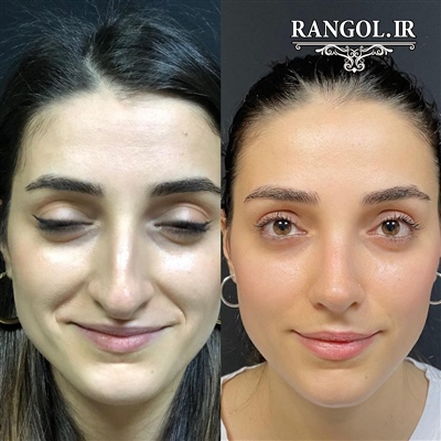 عمل جراحی زیبایی صورت تزریق ژل فیلر نخ