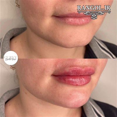 عمل جراحی زیبایی صورت تزریق ژل فیلر نخ