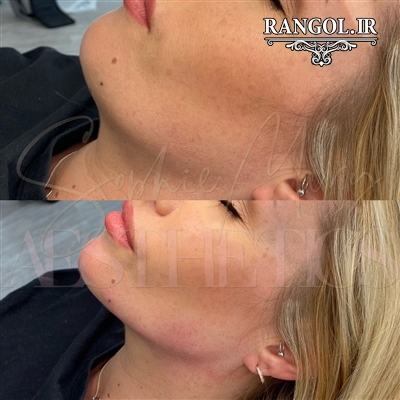 عمل جراحی زیبایی صورت تزریق ژل فیلر نخ