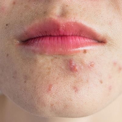 چرا بعد از شیو جوش میزنیم؟